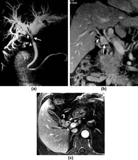 Mrcp And 3d Lava Imaging Of Extrahepatic Cholangiocarcinoma At 3 T Mri