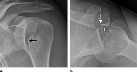 Posterior Glenohumeral Dislocation In A 40 Year Old Man With
