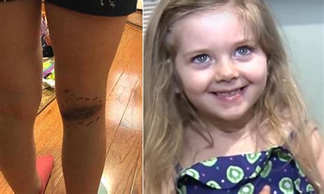 Black Widow Spider Bite Hospitalizes A Five Year Old Girl Daily Mail