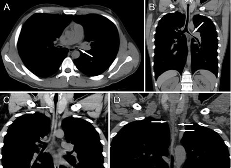 Relapsing Polychondritis Associated Refractory Airway Stenosis The