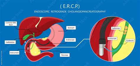 Endoscopic Retrograde Cholangiopancreatography Ercp Diagnose Treat