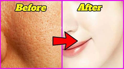 How To Minimize Pores Naturally At Home Thats Really Work In 2 Days Youtube