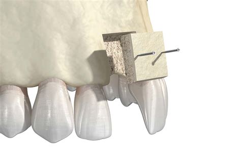 What Is Bone Grafting Texas Specialty Dental Services