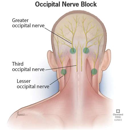 Occipital Nerve Block What It Is Procedure Side Effects