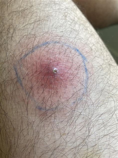 Is This A Spider Bite And Should I Be Worried I Noticed The Area