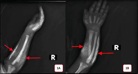 Lateral 1A And Anteroposterior 1B Skiagram Of The Right Forearm