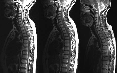 Early Mri Scans Could Predict Multiple Sclerosis Disability Ucl Queen
