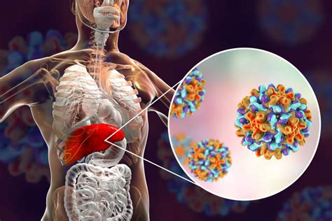 Hepatitis a, b, and c spread in very different ways, causing mild to serious effects on the liver. Mengenal Bahaya Penyakit Hepatitis A, Penyakit yang Sedang ...