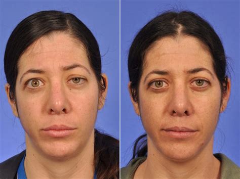 Thyroid Eye Disease Before And After W Cosmetic Surgery