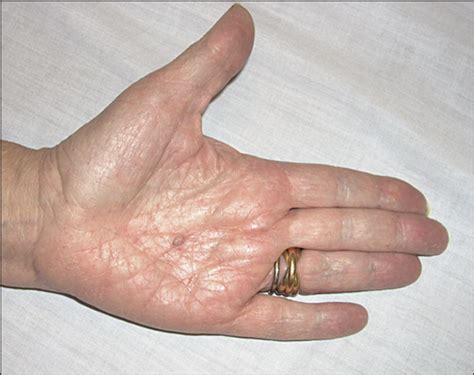 Palmar Basal Cell Carcinoma In A Patient With Gorlin Goltz Syndrome