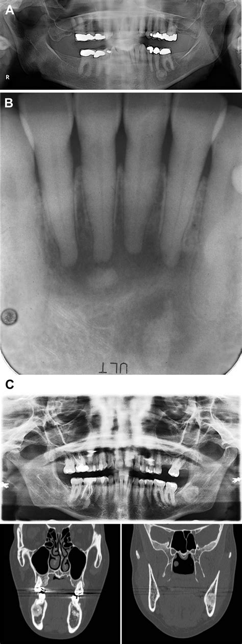 Central Cemento Ossifying Fibroma Primary Odontogenic Or Osseous