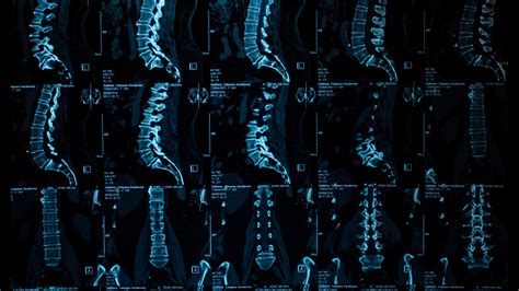 Degenerative Spine Conditions And Treatment Spinal Backrack