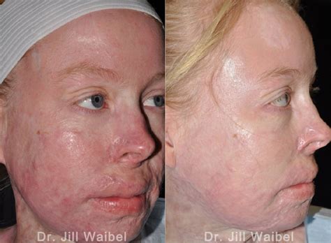 Burn Scar Treatment Before And After Pictures In Miami Fl