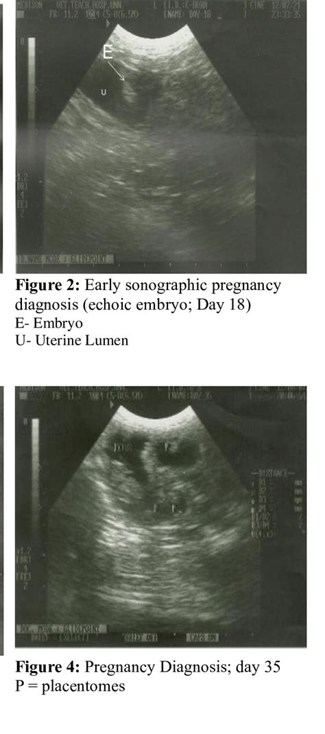 Early Sonographic Pregnancy Diagnosis Circumscribed Anechoic Fluid