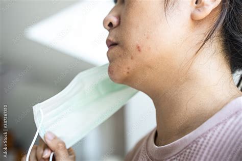 Asian Woman With Acne On The Face Caused By Wearing Medical Mask