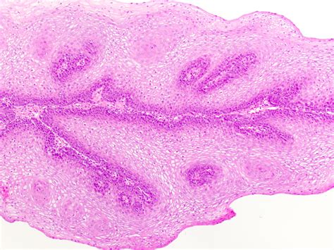 Pathology Outlines Squamous Cell Papilloma