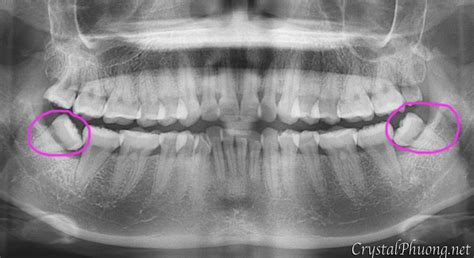 Most adults have no more than four wisdom teeth, which means that a simple extraction could still cost you as much as $600. STORY OF MY WISDOM TOOTH EXTRACTION | CrystalPhuong ...