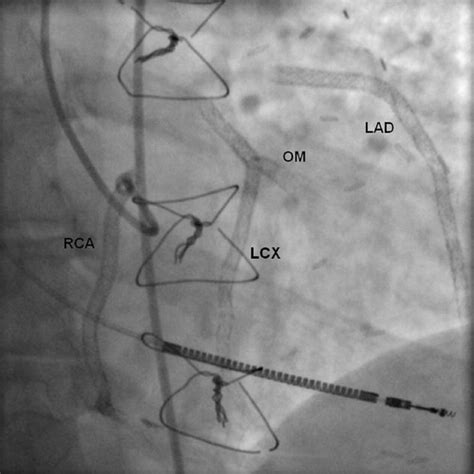 A Heart With 67 Stents Journal Of The American College Of Cardiology