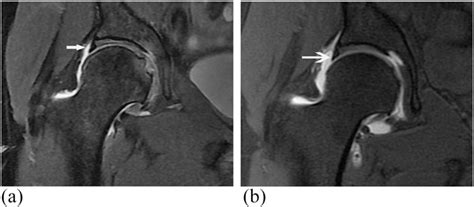 Figure 2 From Comparison Of 30 T Mr Vs 30 T Mr Arthrography Of The