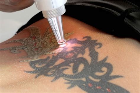 In order to give our customers a better estimate of the costs for a tattoo removal, following table exemplarly shows costs for laser tattoo removal based on the size of the tattoo. Laser Tattoo Removal - Everything You Need to Know