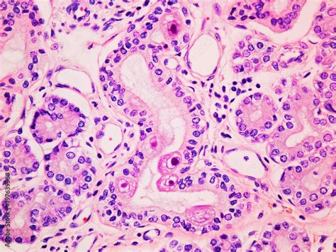 Cytomegalovirus Cmv Infection In The Salivary Gland Viewed At 400x