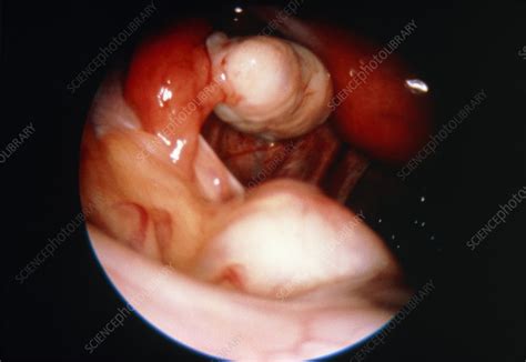 Baby inside woman womb free vector. Endoscope view of healthy human ovaries and uterus - Stock Image - P616/0125 - Science Photo Library