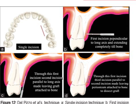 44 Year Journey Of Palatal Connective Tissue Graft Harvest A Narrative