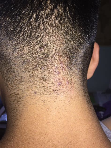 Bumps On The Back Of My Head Wont Go Away Can Anyone Help With Any