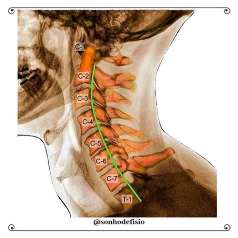 C a C A coluna cervical é composta por vértebras sequenciais que sã Coluna cervical