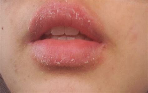 Eczema On Lips Pictures Causes Contagious Treatment Home Remedies