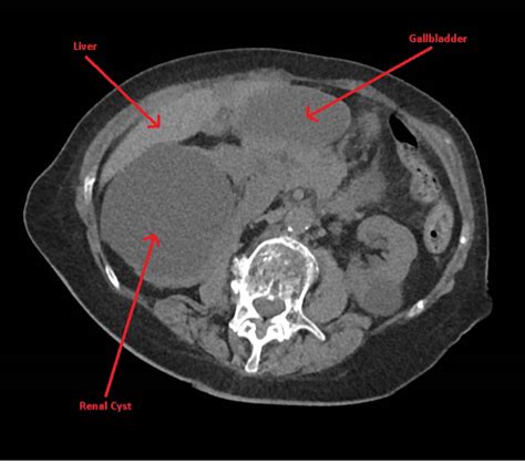 Cureus Gallbladder Volvulus Presenting As Acute Appendicitis