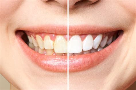 Tooth Discoloration Causes And Prevention