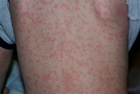 Viral Rash Pictures
