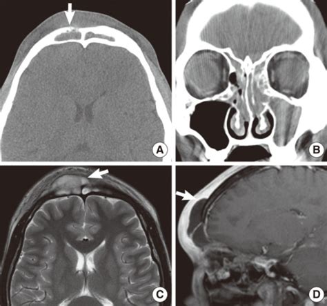 A Axial Ct Showing Left And Right Frontal Sinusitis W Open I