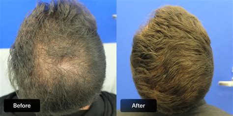 Topical Finasteride Reduced Side Effects Amazing Results