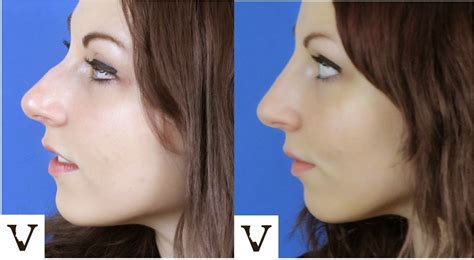 Check spelling or type a new query. LOVE YOUR FACE: Non-surgical nosejob-specialty of Visage ...