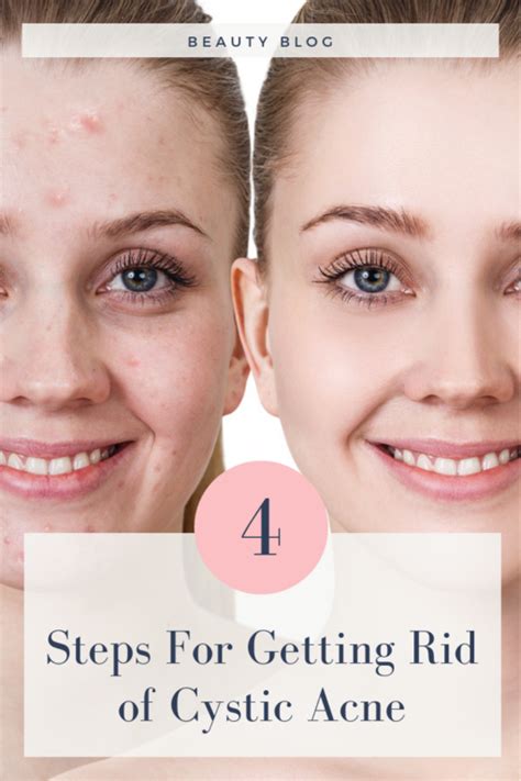 4 Steps For Getting Rid Of Cystic Acne Biodroga And Dr Grandel