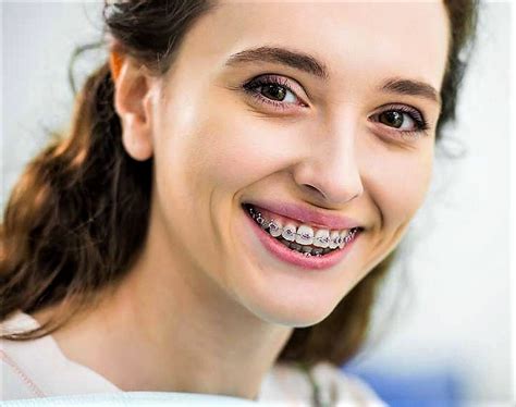 Pin By Shrood Burgos On Girls In Braces Braces Girls Beautiful Smile Perfect Teeth