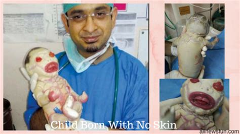 Baby Born Without Skin In India Harlequin Ichthyosis