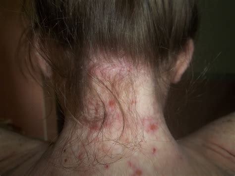 Bumps On Hairline On Back Of Neck Pictures Photos