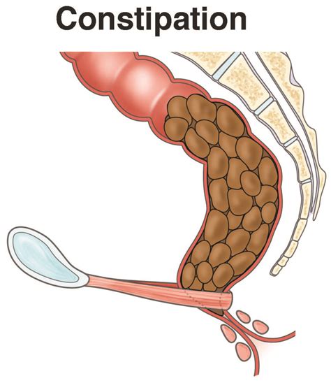 Stomach Pain After Constipation