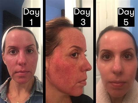 Download Fraxel Laser Before And After Acne Scars Pictures Just Sharing