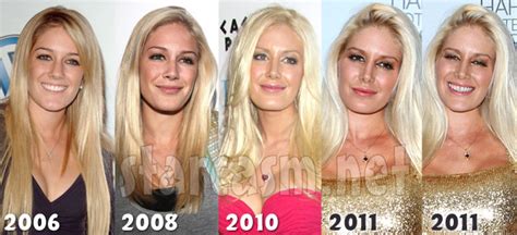 Photos Heidi Montag How Is Her Face Holding Up After Those Plastic Surgeries