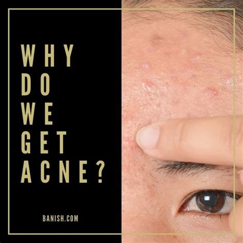Why Do We Get Acne In The First Place