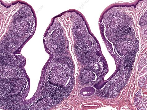 Lingual Tonsil Human Lm Stock Image C0362325 Science Photo Library