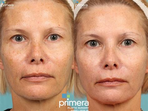 Cynosure Icon Ipl Before And After Photo Gallery Orlando Florida