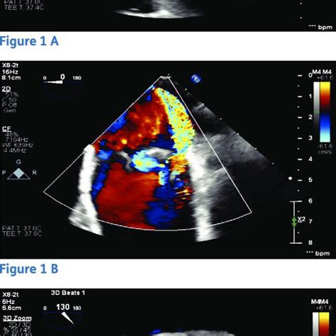 Transesophageal Echocardiogram View Of Bioprosthetic Mitral Valve