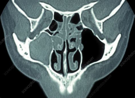 Infected Maxillary Sinus Ct Scan Stock Image M2600404 Science