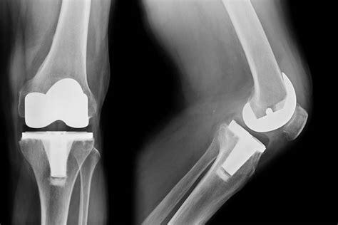 Revision Joint Replacement Surgery In Ahmednagar Dr Prashant Kale