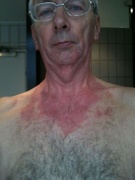 I Have Had A Red Rash On My Chest For The Last 8 Weeks From
